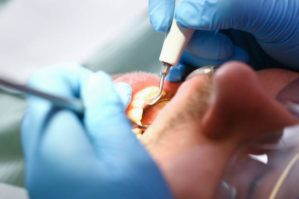 Best Emergency Wisdom Teeth Removal in Pine Bluffs, WY
